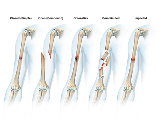 sports-injuries-types-of-fractures-simple-compound